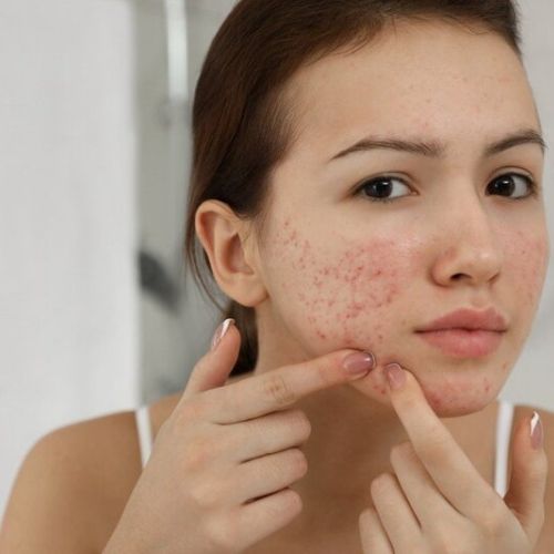 Bị dị ứng khi dùng kem chống nắng? Nguyên nhân và cách khắc phục?