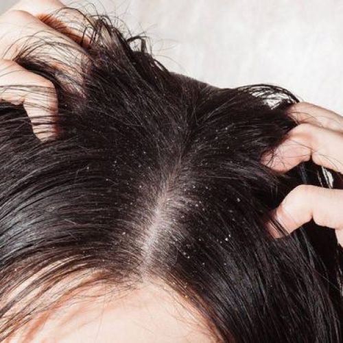 CÁCH TRỊ GÀU TẠI NHÀ VỚI NGUYÊN LIỆU THIÊN NHIÊN AN TOÀN & HIỆU QUẢ