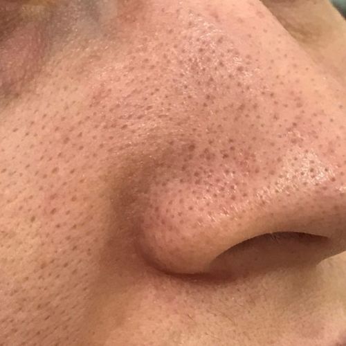7 CÁCH ĐIỀU TRỊ MỤN ĐẦU ĐEN ĐƠN GIẢN, HIỆU QUẢ TẠI NHÀ