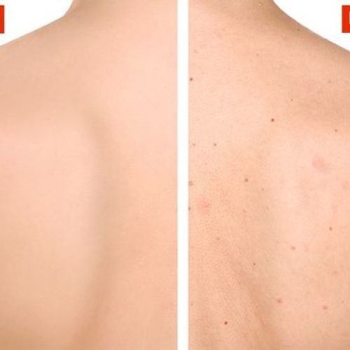 CÁCH ĐIỀU TRỊ MỤN LƯNG HIỆU QUẢ TẠI NHÀ