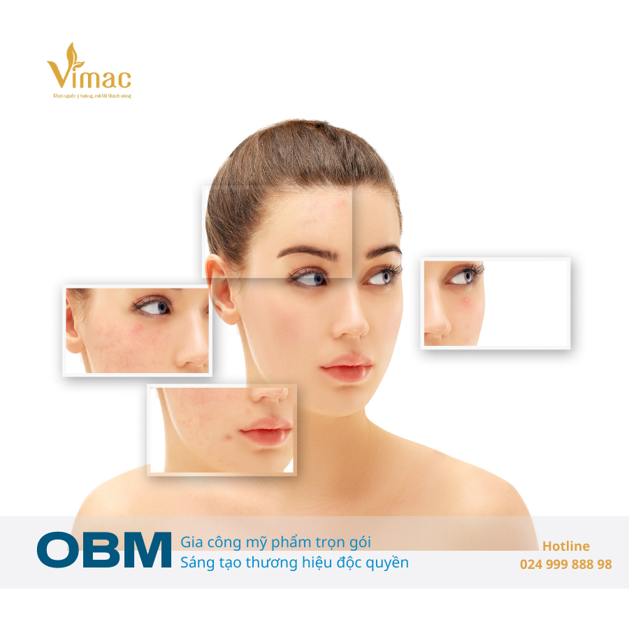 kem trị thâm mụn