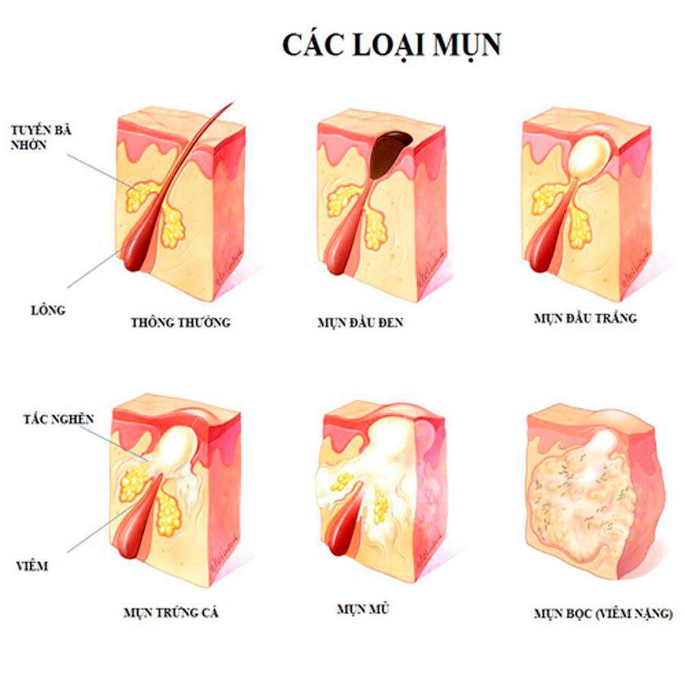 4. Phòng ngừa mụn lưng hiệu quả