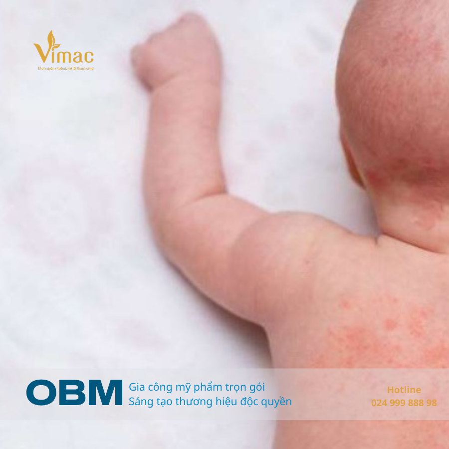 trẻ bị rôm sảy